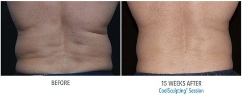 CoolSculpting Fat Freezing Treatments, Side Effects & Results.